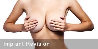 San Antonio Symmastia Breast Implant Revision Surgery: Uniboob