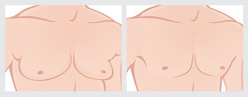 Breast Reduction In Austin, TX