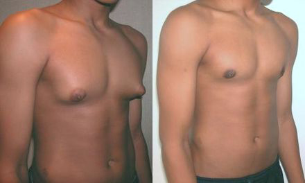Male Breast Reduction (Gynecomastia), Austin, Texas