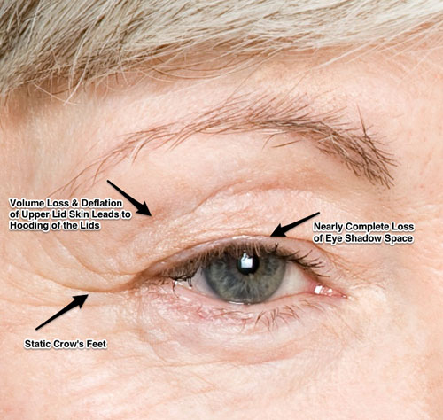 eyelid skin
