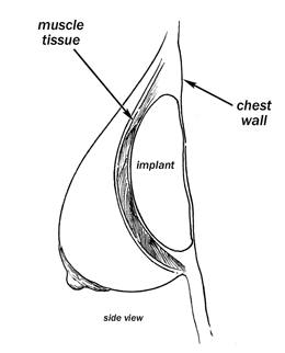 https://www.restoraaustin.com/wp-content/uploads/2016/07/breast-diagram.png