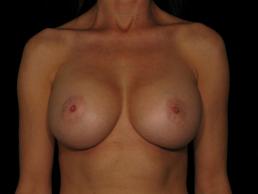 breast-augmentation-austin-tx