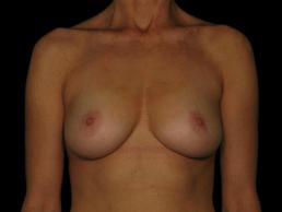 breast-augmentation-austin-tx