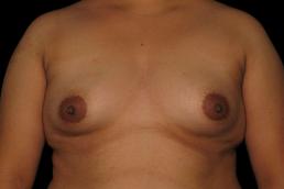 breast-augmentation-austin-tx