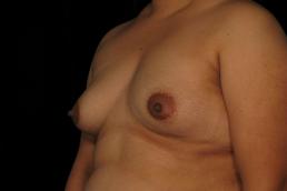 breast-augmentation-austin-tx