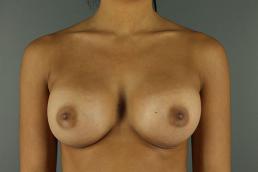 breast-augmentation-austin-tx