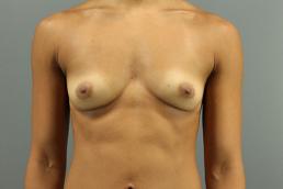 breast-augmentation-austin-tx