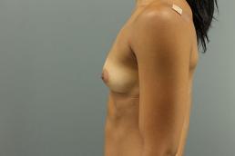 breast-augmentation-austin-tx