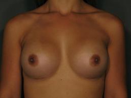 breast-augmentation-austin-tx