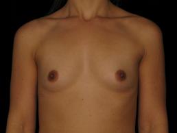 breast-augmentation-austin-tx