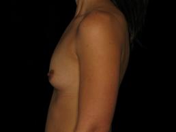 breast-augmentation-austin-tx