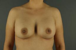 breast-augmentation-austin-tx