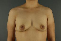 breast-augmentation-austin-tx