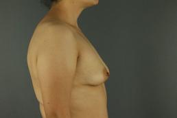 breast-augmentation-austin-tx