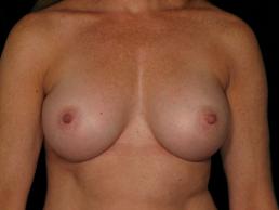 breast-augmentation-austin-tx