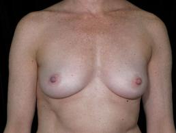 breast-augmentation-austin-tx