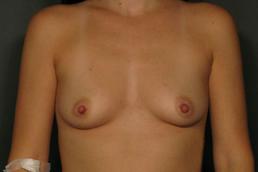 breast-augmentation-austin-tx