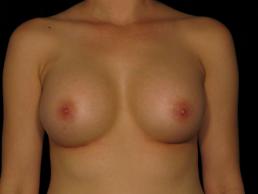 breast-augmentation-austin-tx