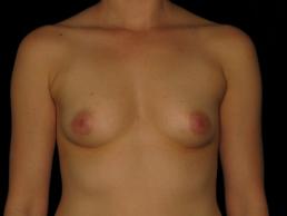 breast-augmentation-austin-tx