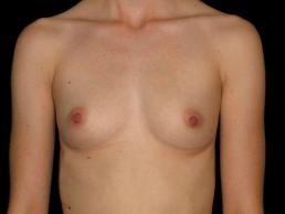 breast-augmentation-austin-tx