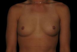 breast-augmentation-austin-tx