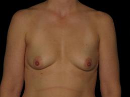 breast-augmentation-austin-tx