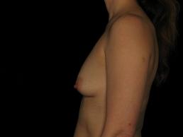 breast-augmentation-austin-tx