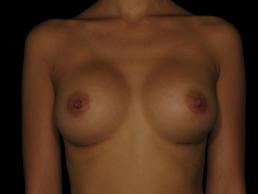 breast-augmentation-austin-tx