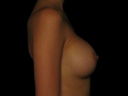 breast-augmentation-austin-tx