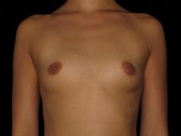 breast-augmentation-austin-tx