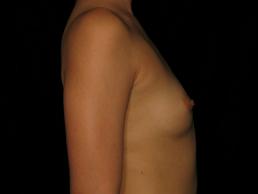 breast-augmentation-austin-tx