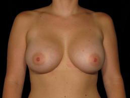 breast-augmentation-austin-tx