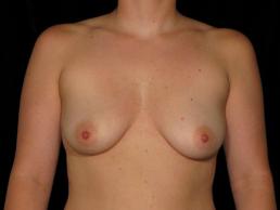 breast-augmentation-austin-tx