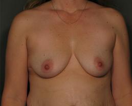 breast-augmentation-austin-tx