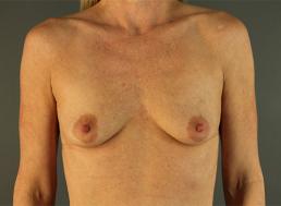 breast-augmentation-austin-tx