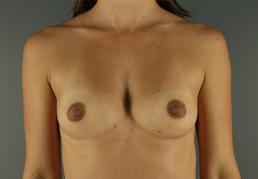 breast-augmentation-austin-tx