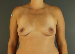 breast-augmentation-austin-tx