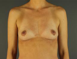 breast-augmentation-austin-tx