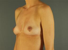 breast-augmentation-austin-tx