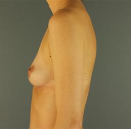 breast-augmentation-austin-tx