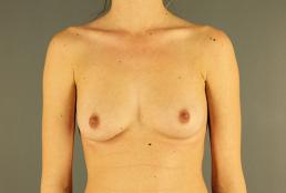 breast-augmentation-austin-tx