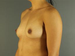 breast-augmentation-austin-tx