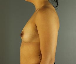 breast-augmentation-austin-tx