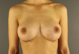 breast-augmentation-austin-tx