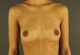 breast-augmentation-austin-tx