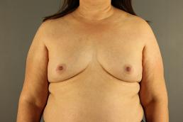 breast-augmentation-austin-tx