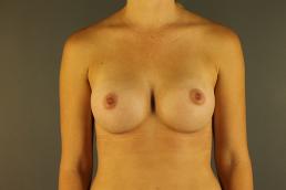 breast-augmentation-austin-tx