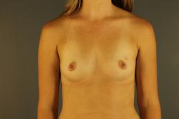 breast-augmentation-austin-tx