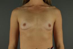 breast-augmentation-austin-tx