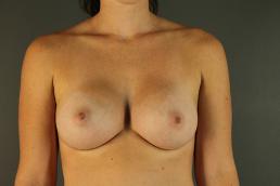 breast-augmentation-austin-tx